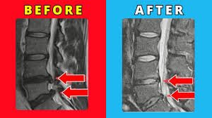 Slip Disc L4,L5 Treat Without Surgery